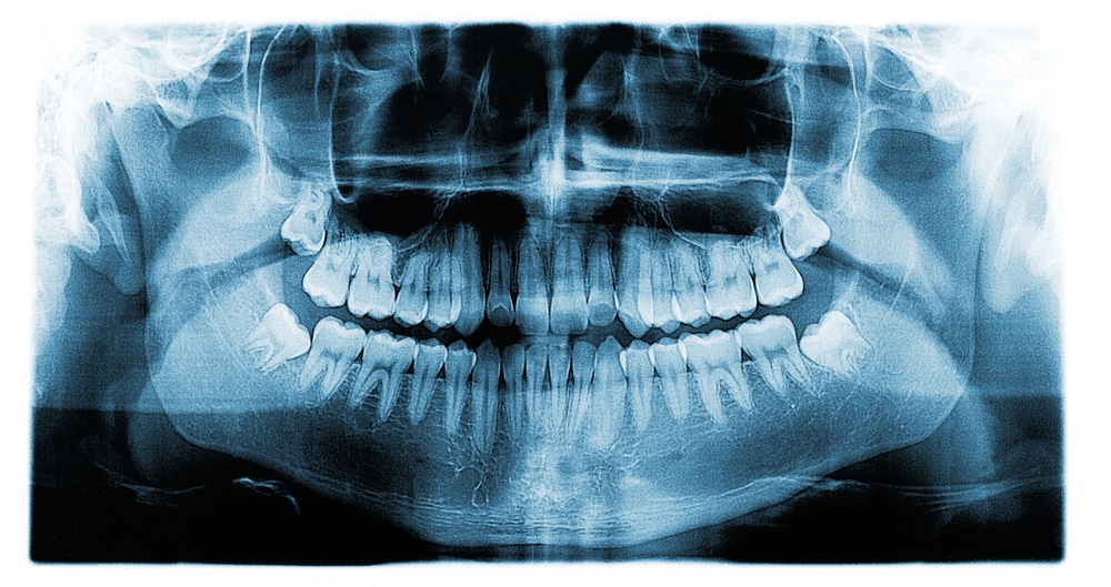 Digital X-rays