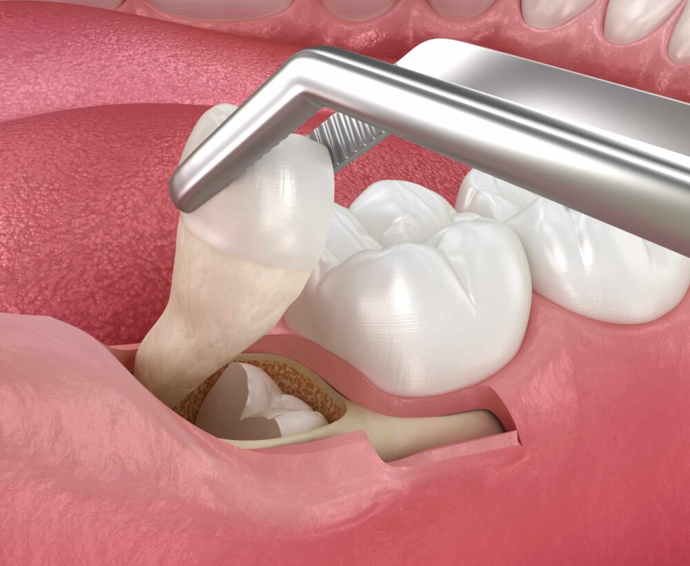 Tooth Extractions Purcellville